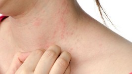 Ciri-ciri dan Cara Mengatasi Alergi Udang