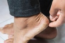 Beberapa Penyebab dan Cara Mengatasi Tumit Kaki Pecah-pecah