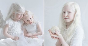 Faktor Penyebab dan Jenis  Albino
