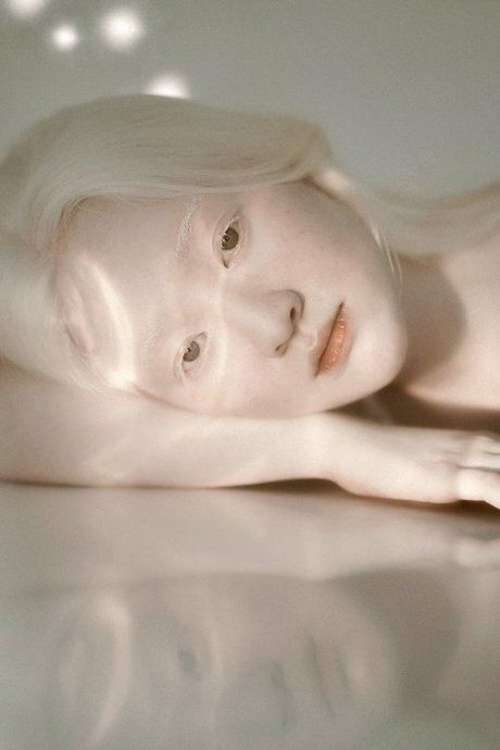 Mengenal Faktor Penyebab Albino, yang Jarang Orang Ketahui